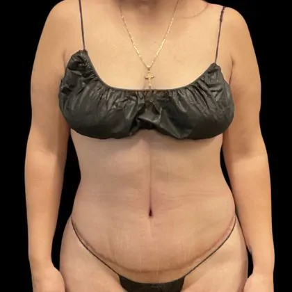 body lift after