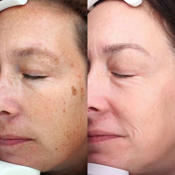 bbl + moxi before and after