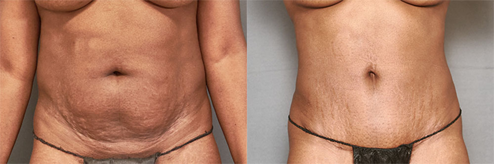 tummy tuck before and after