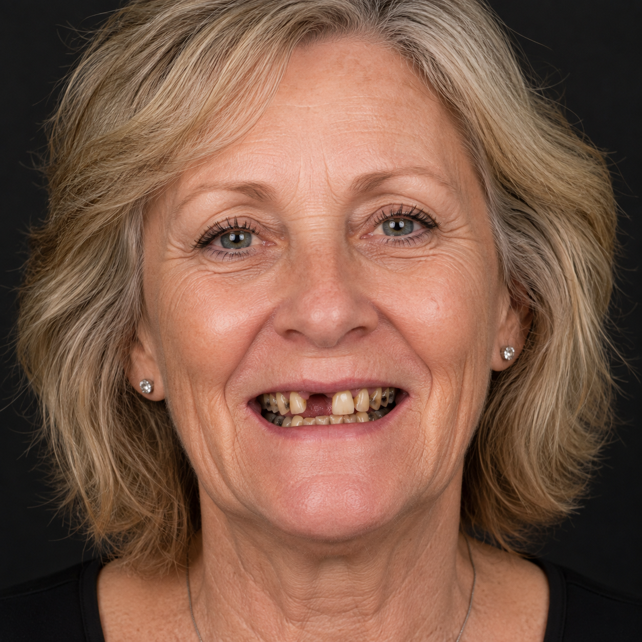 Before full arch restoration, age 61, multiple missing teeth
