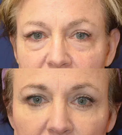 blepharoplasty before & after