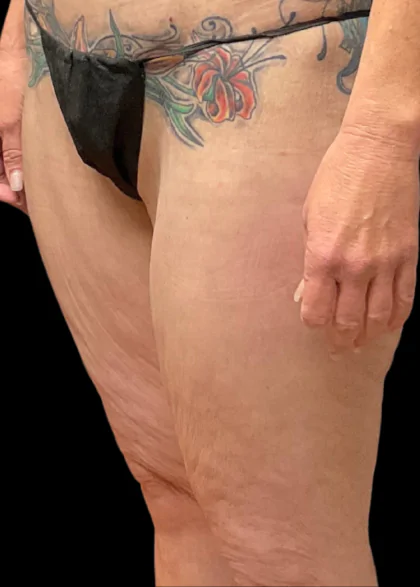 body lift before
