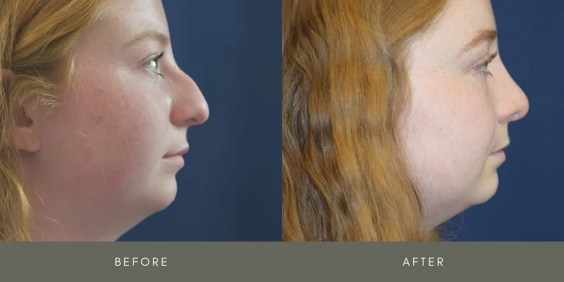 rhinoplasty before & after