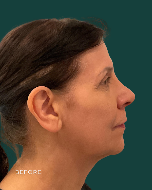 facelift before & after photo