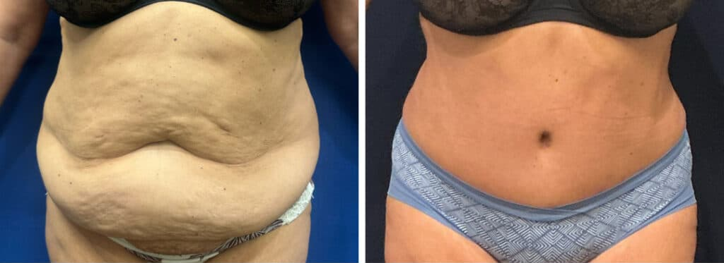 abdominoplasty patient 3 before & after