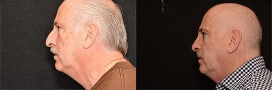 rhinoplasty before and after patient 5