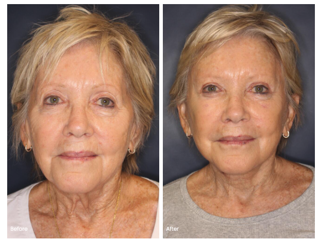 deep plane facelift before and after