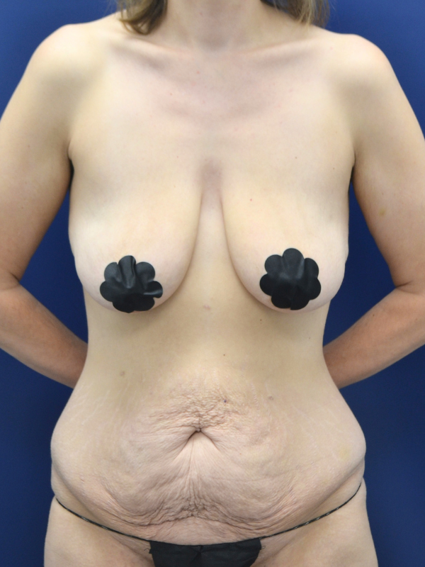 body lift before photo