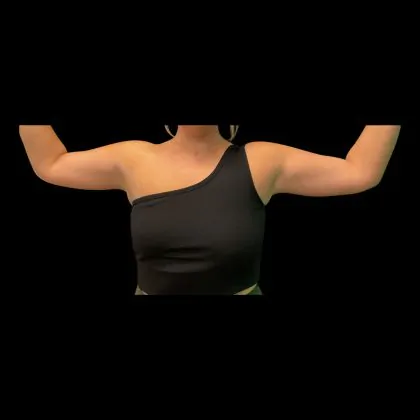 body lift after