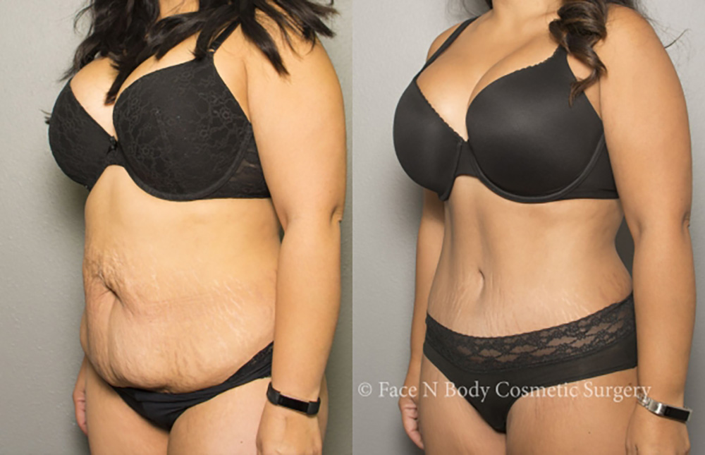 tummy tuck before and after