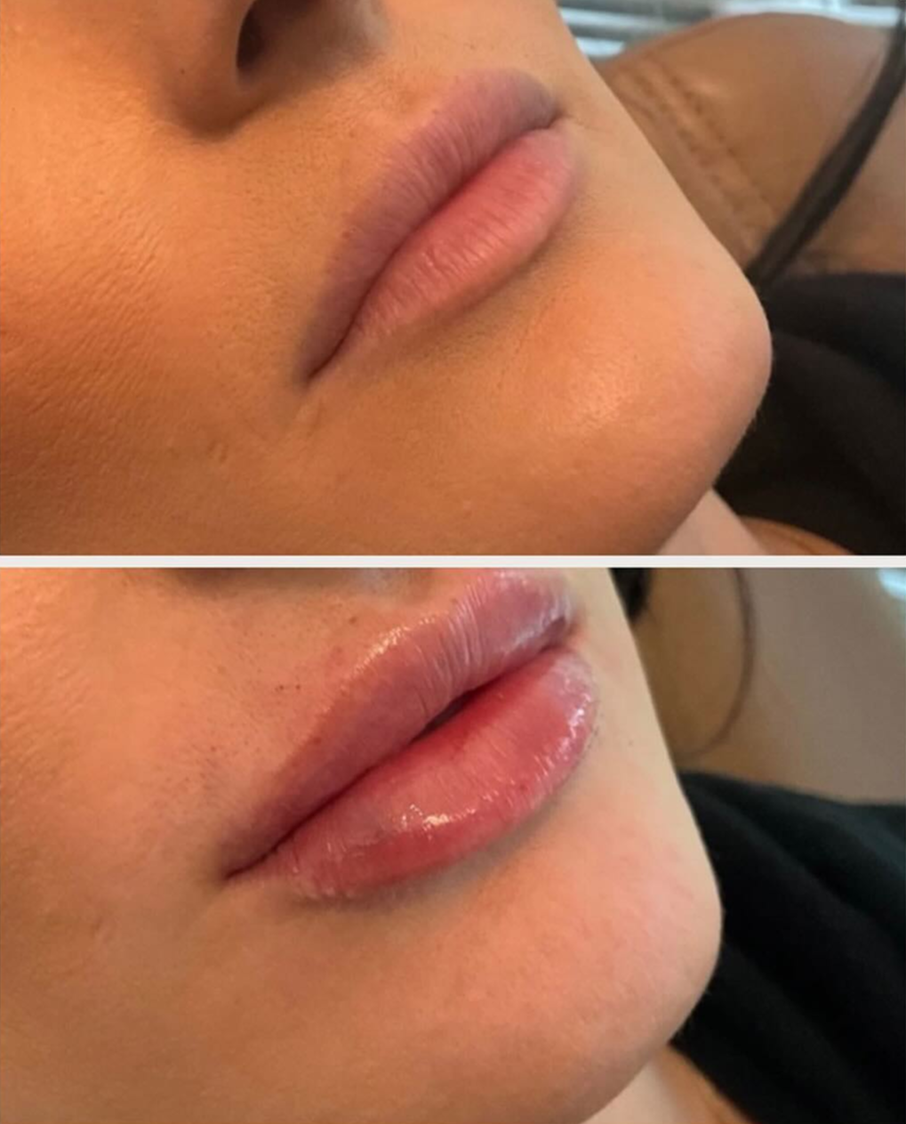 lip filler patient 8 before & after