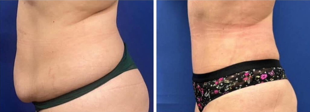 tummy tuck patient 1 before & after