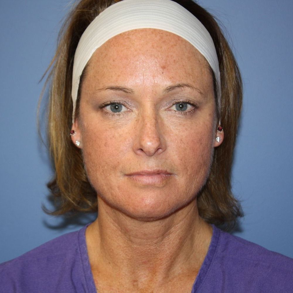 Facial Rejuvenation Before Photo Facial Rejuvenation Before Photo
