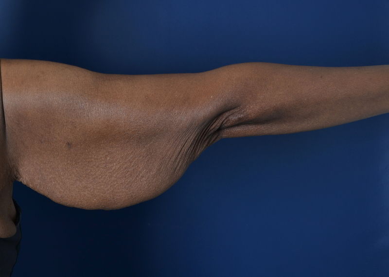 arm lift before photo