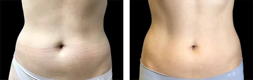 before and after hair removal on legs