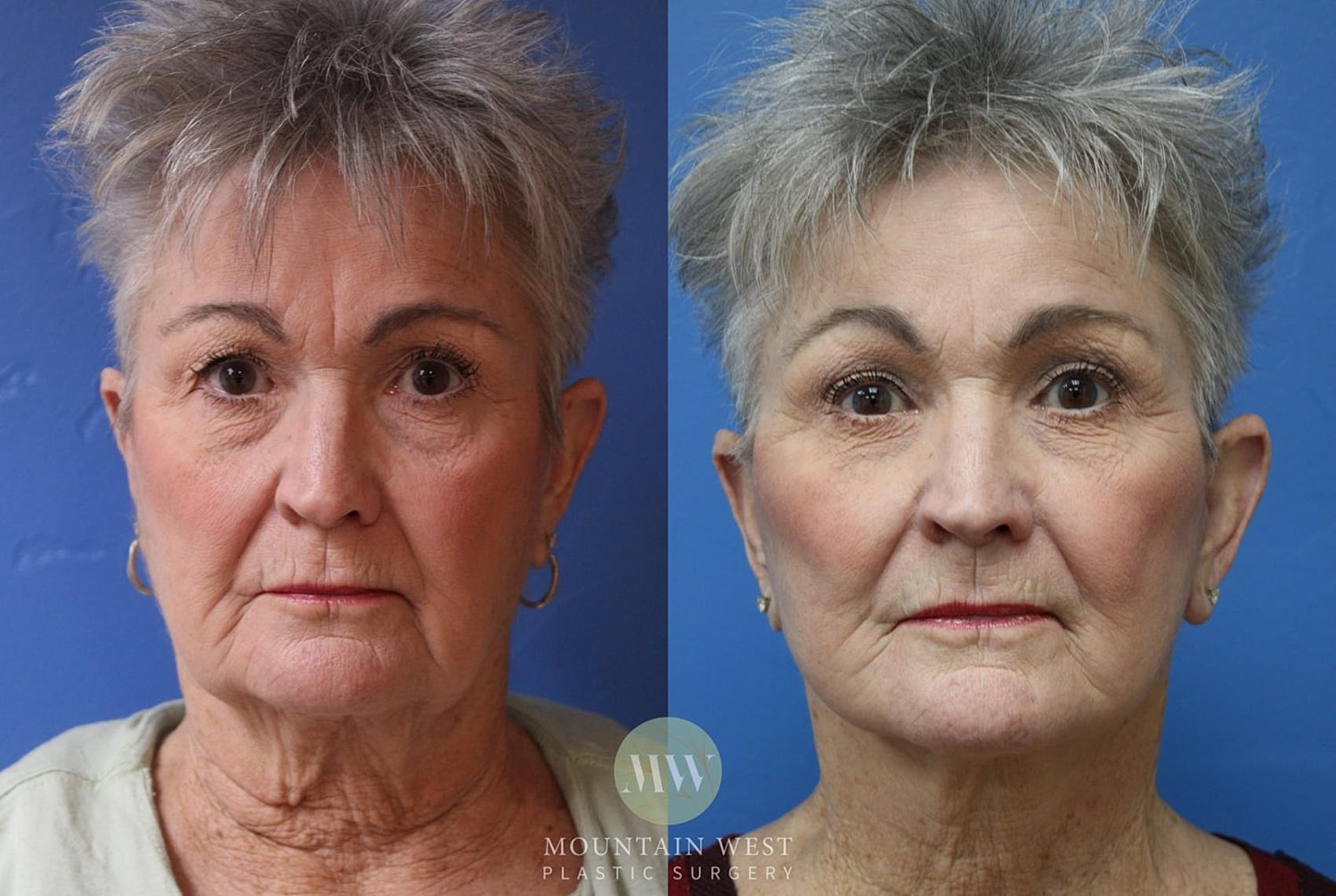 facelift before and after