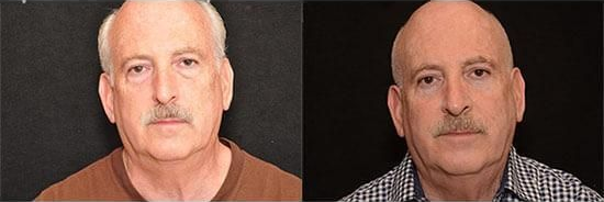 rhinoplasty before and after patient 5