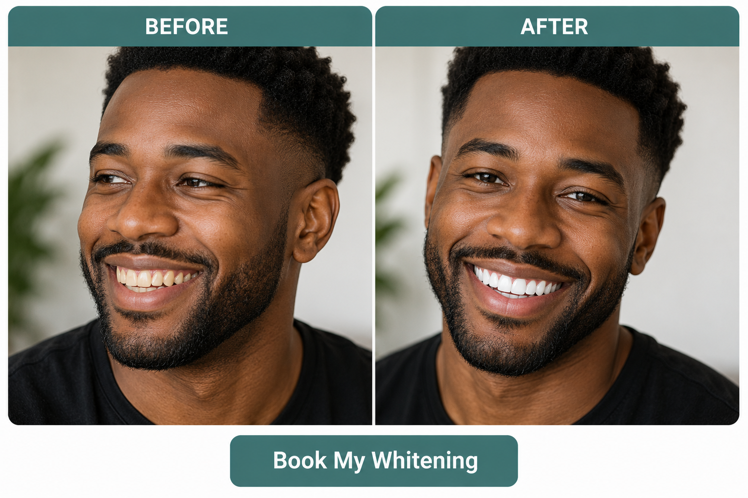 Patient before and after Zoom whitening with a noticeably whiter smile