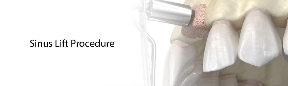 Sinus lift procedure