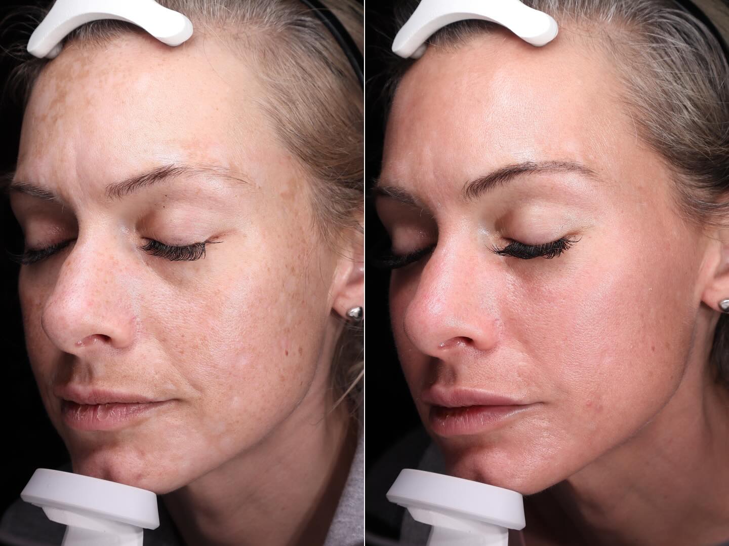 BBL + Moxi before and after