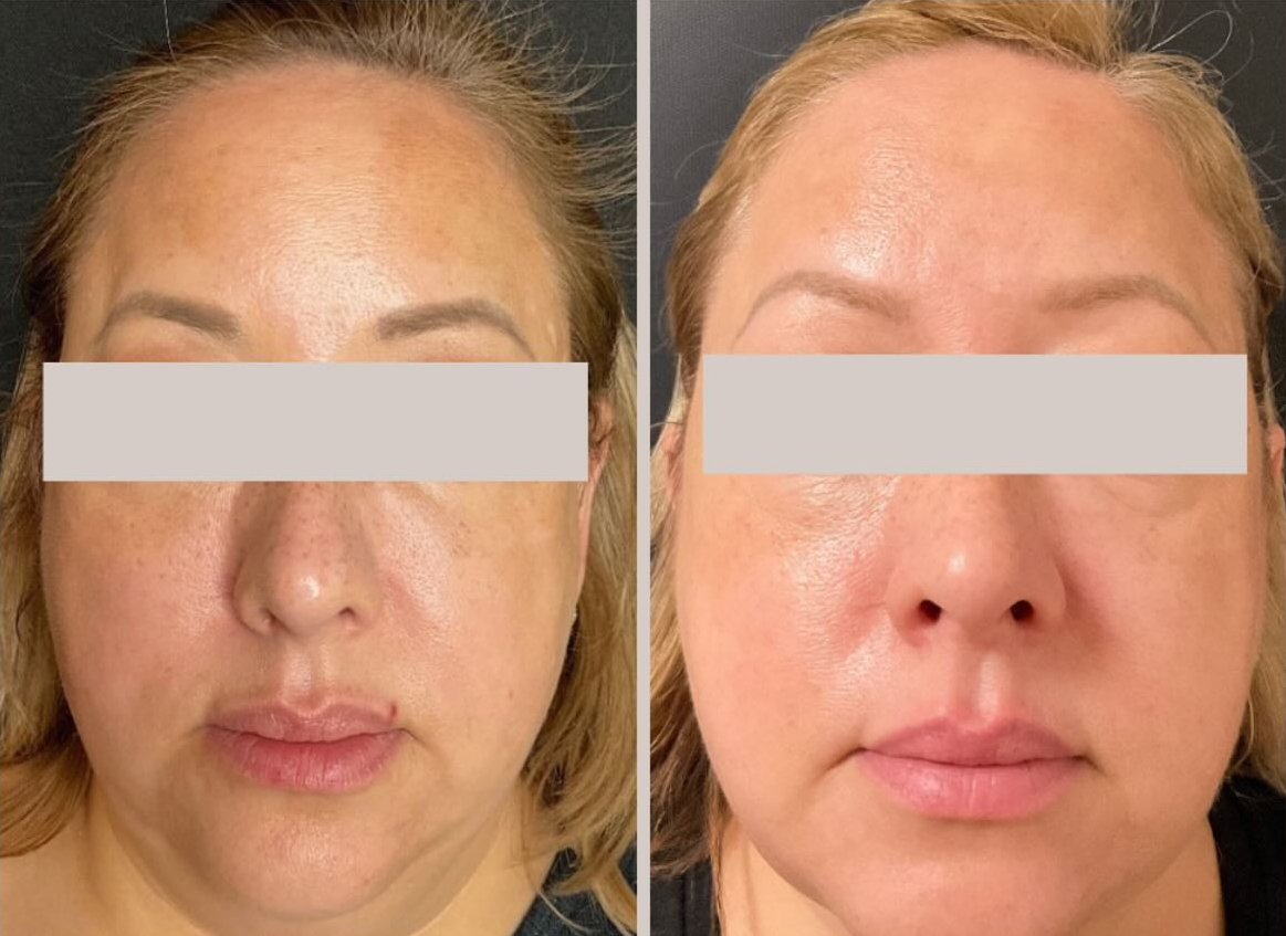 Clear + Brilliant Laser Skin Resurfacing patient before & after