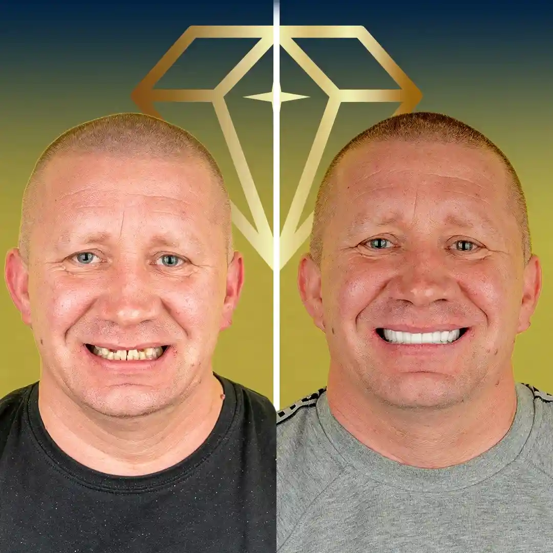 alt="Before and after dental implants transformation at Kristal Clinic"
