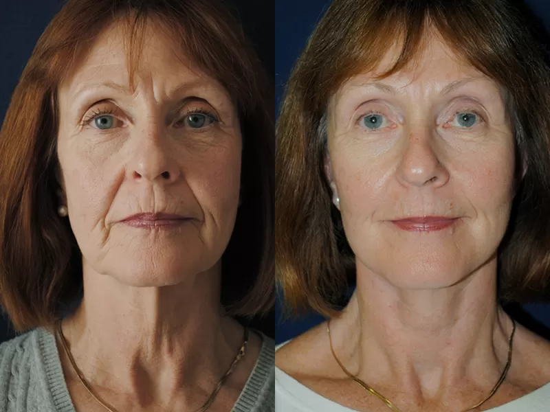 facelift and neck lift before & after
