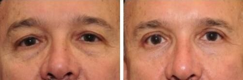 blepharoplasty patient 9 before and after