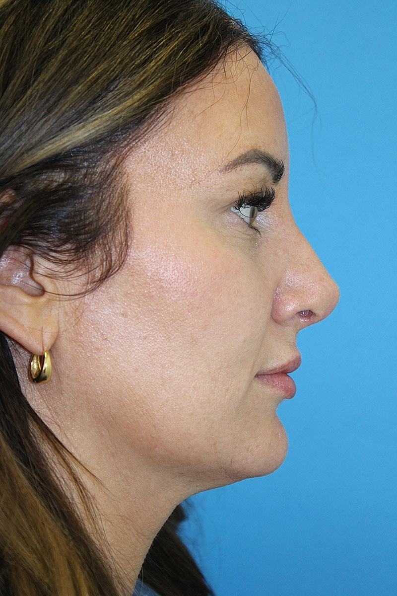 rhinoplasty before and after