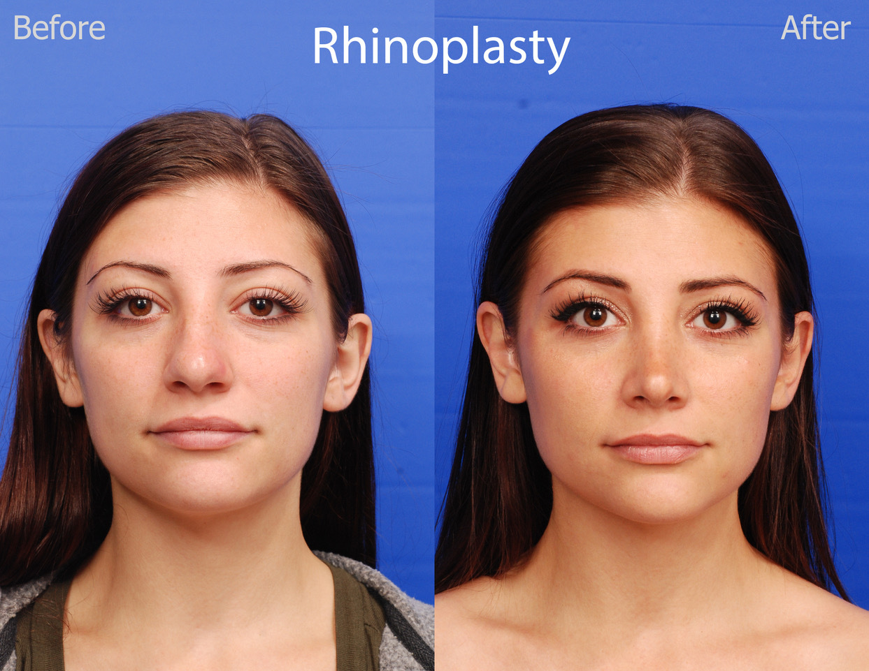 rhinoplasty before and after