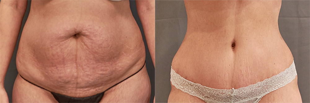 tummy tuck before and after
