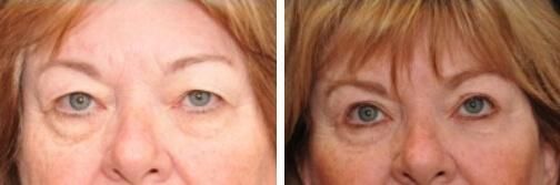 blepharoplasty patient 8 before and after