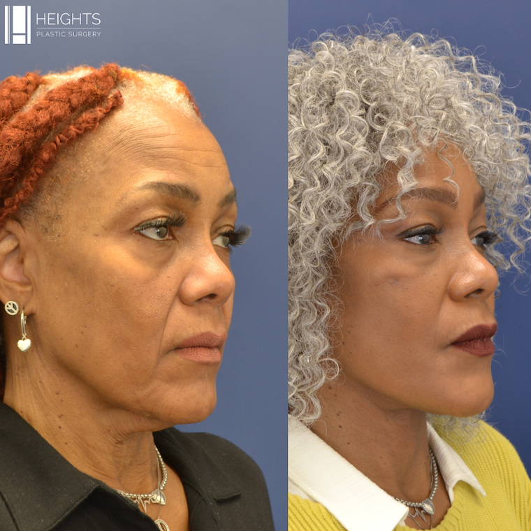 Facelift Before & after