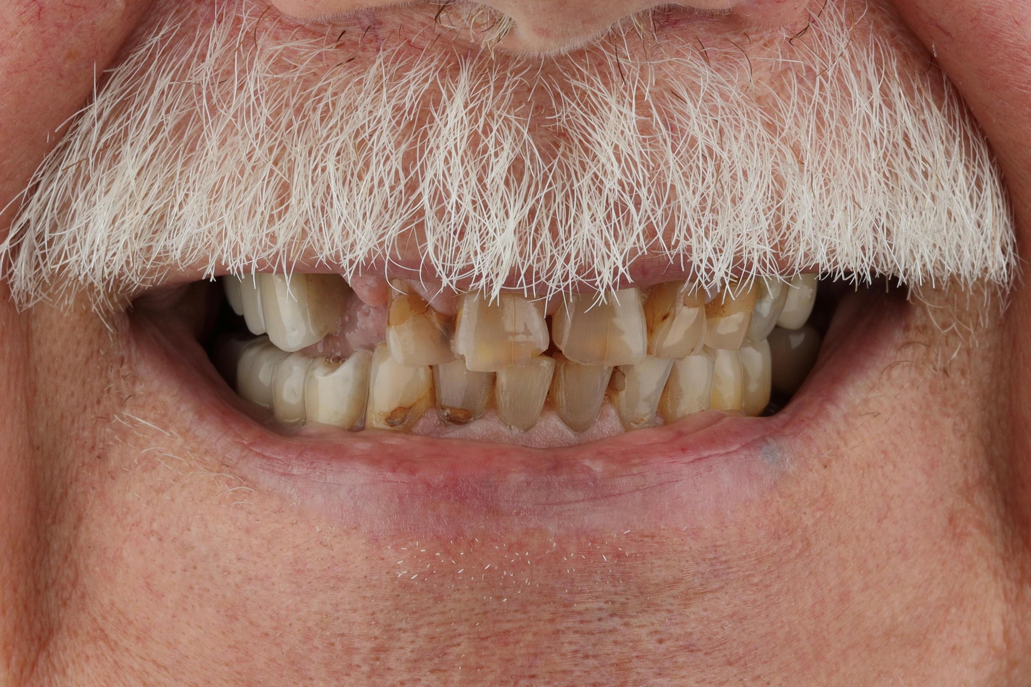 dental implants patient before