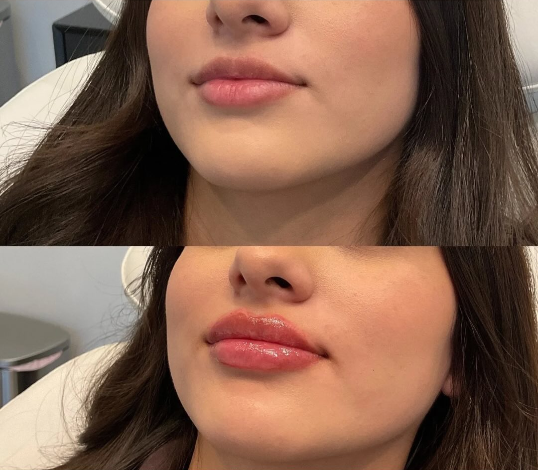 lip filler patient 7 before & after