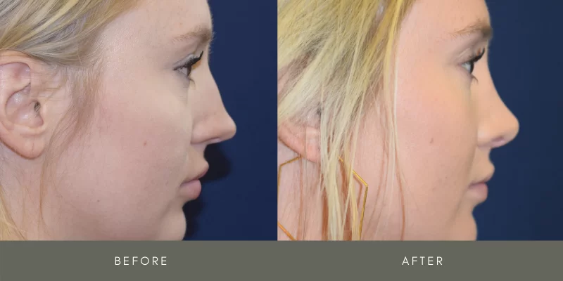 rhinoplasty before & after