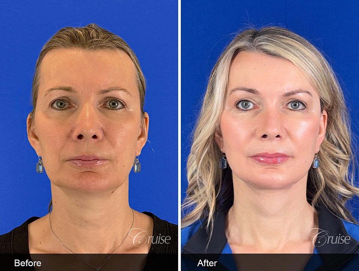 facelift before and after