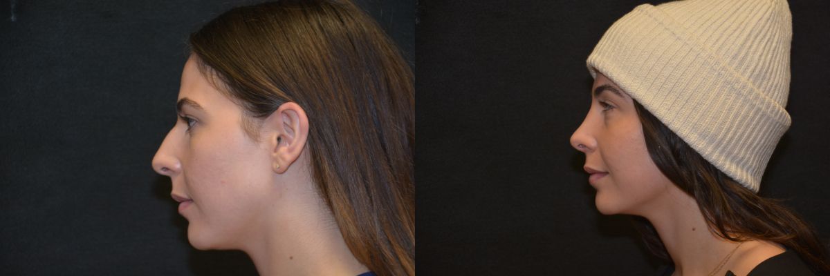 cosmetic nose surgery before and after patient 3