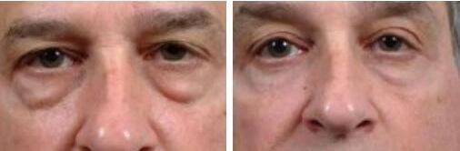 blepharoplasty patient 6 before and after