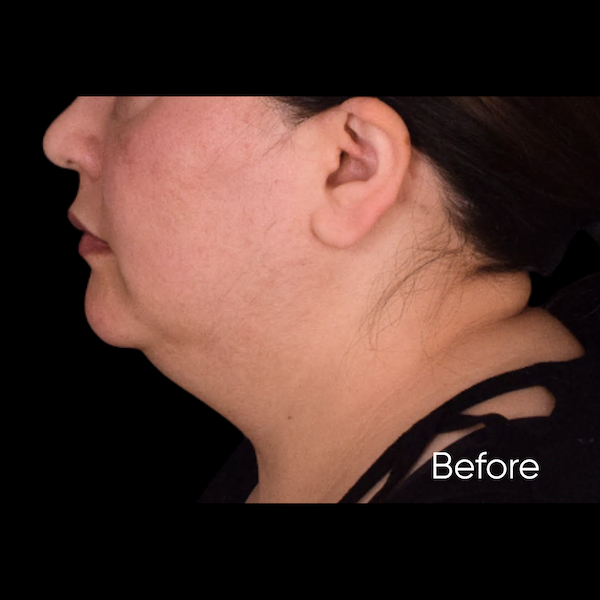 facelift before & after photo