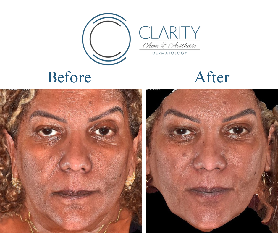 microneedling before & after