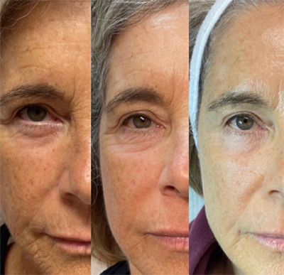 microneedling results