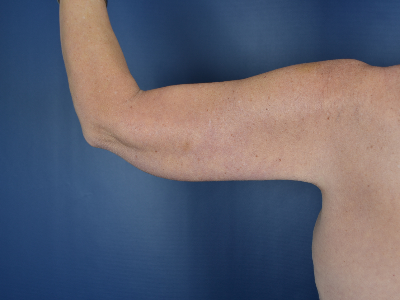 arm lift after photo