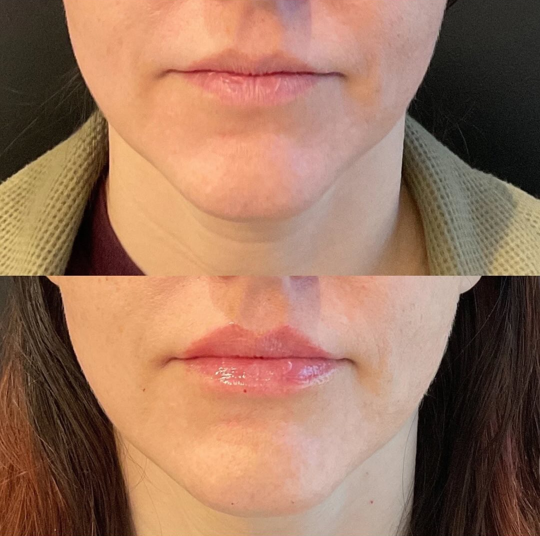 lip filler patient 1 before & after