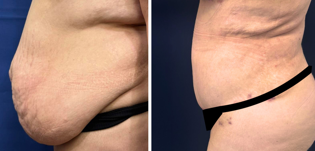 tummy tuck surgery patient 5 before & after