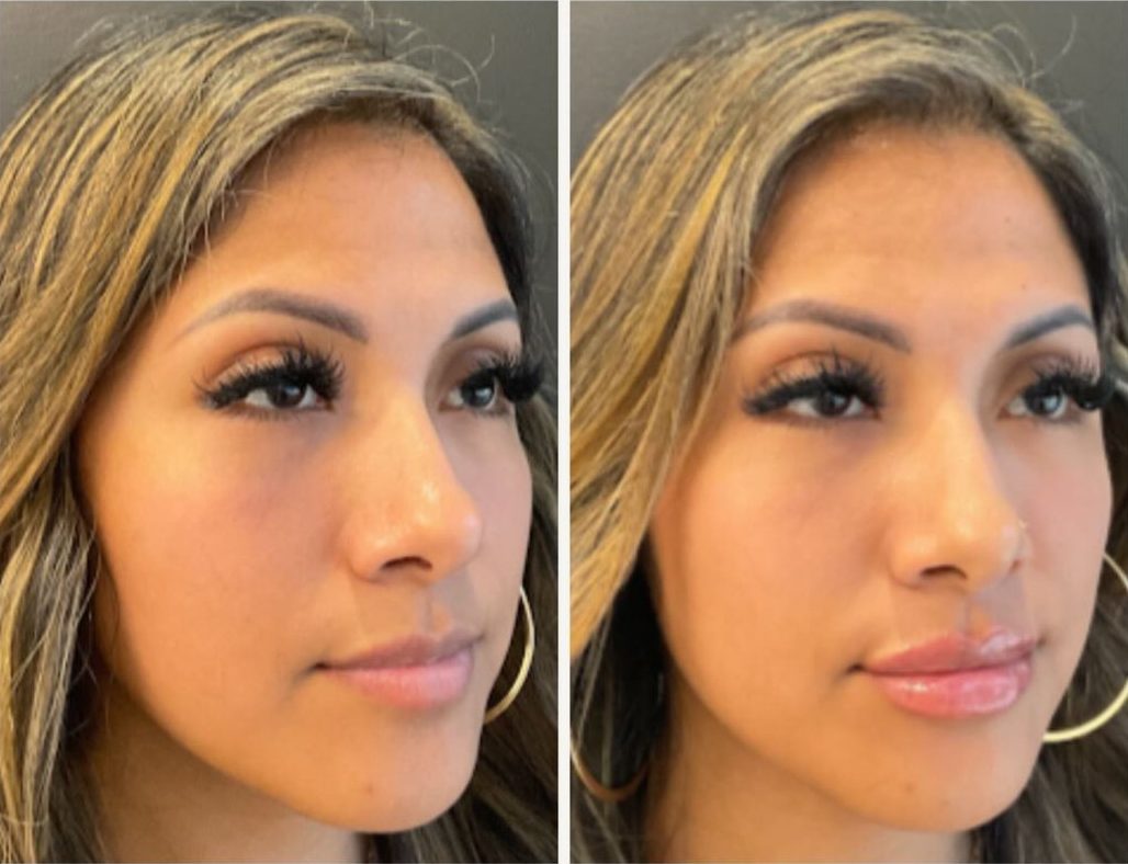 Versa Lip filler patient before & after