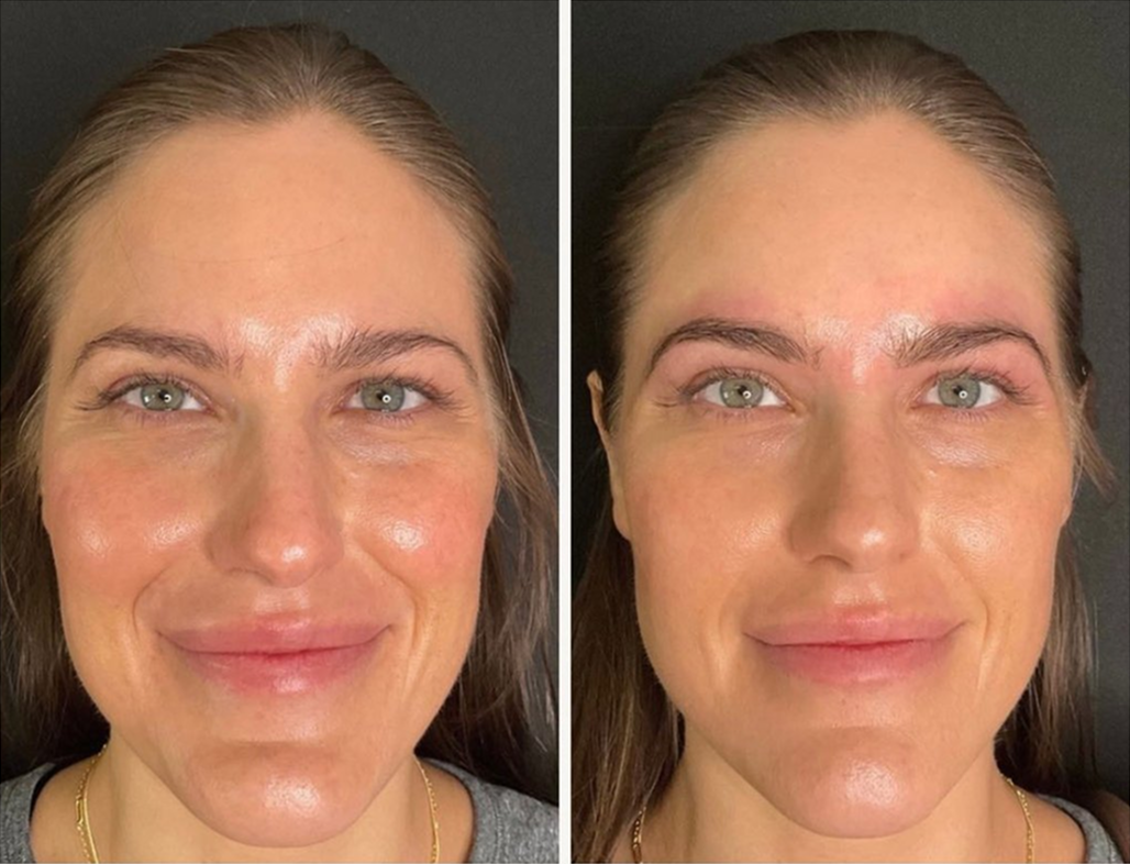 Brow wax & tint patient before & after