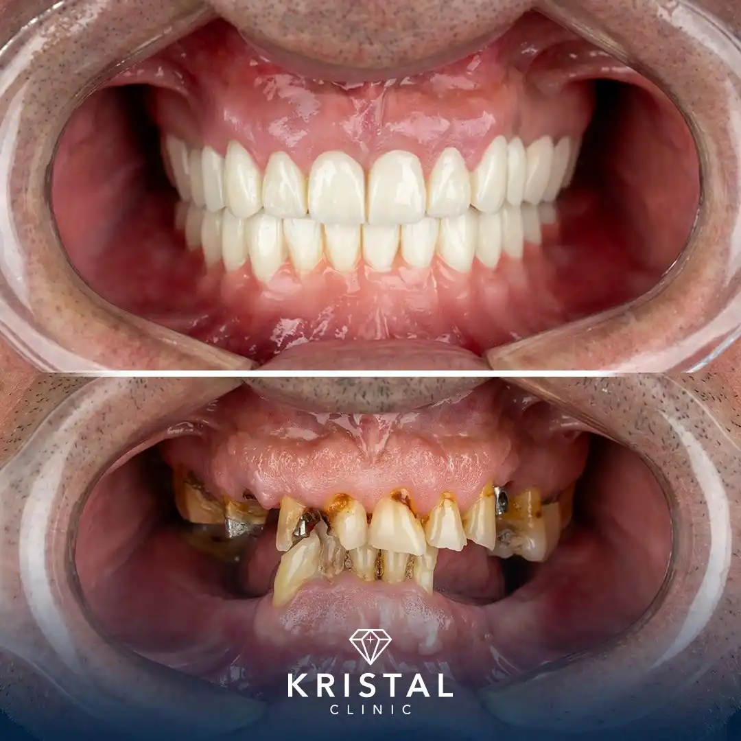 alt="Before and after dental implants transformation at Kristal Clinic"