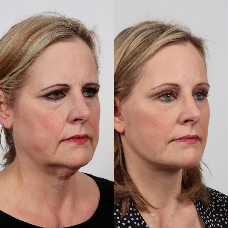 face and neck lift before and after