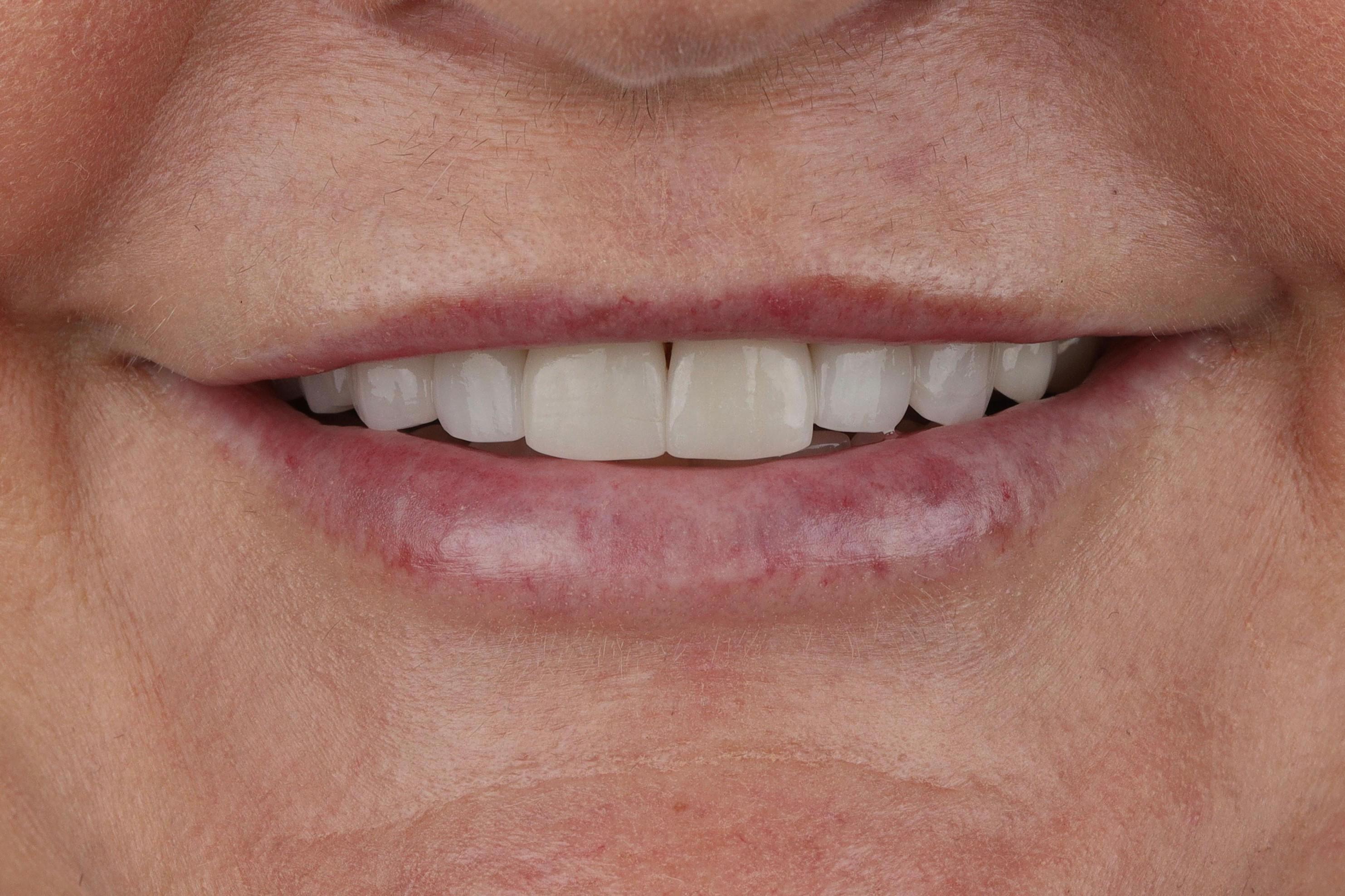 dental implants patient before